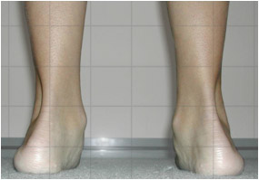 Pronation of Ankles