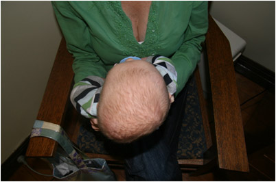 Plagiocephaly or flat head syndrome