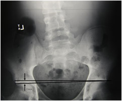 Xray of Scoliosis